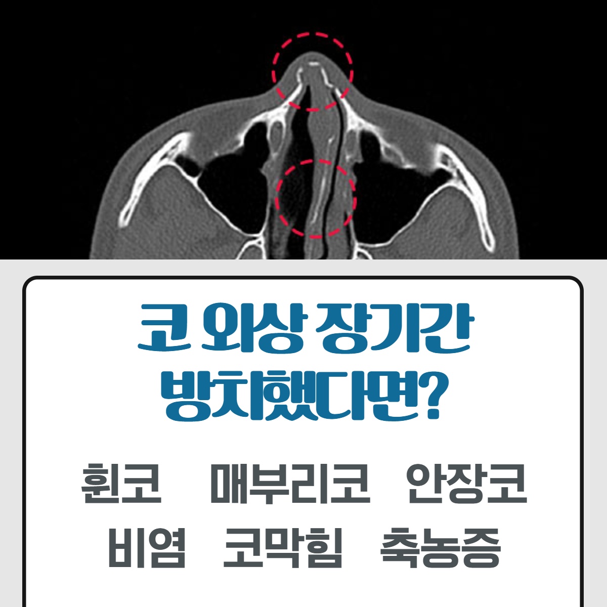 [수원 성형외과] 코 뼈 골절 성형외과로 가야 하는 이유는? (7/10)