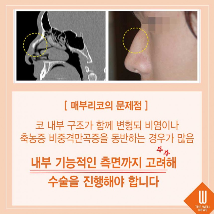 사나운 인상 매부리코성형 비염까지 한 번에 해결! (3/6)