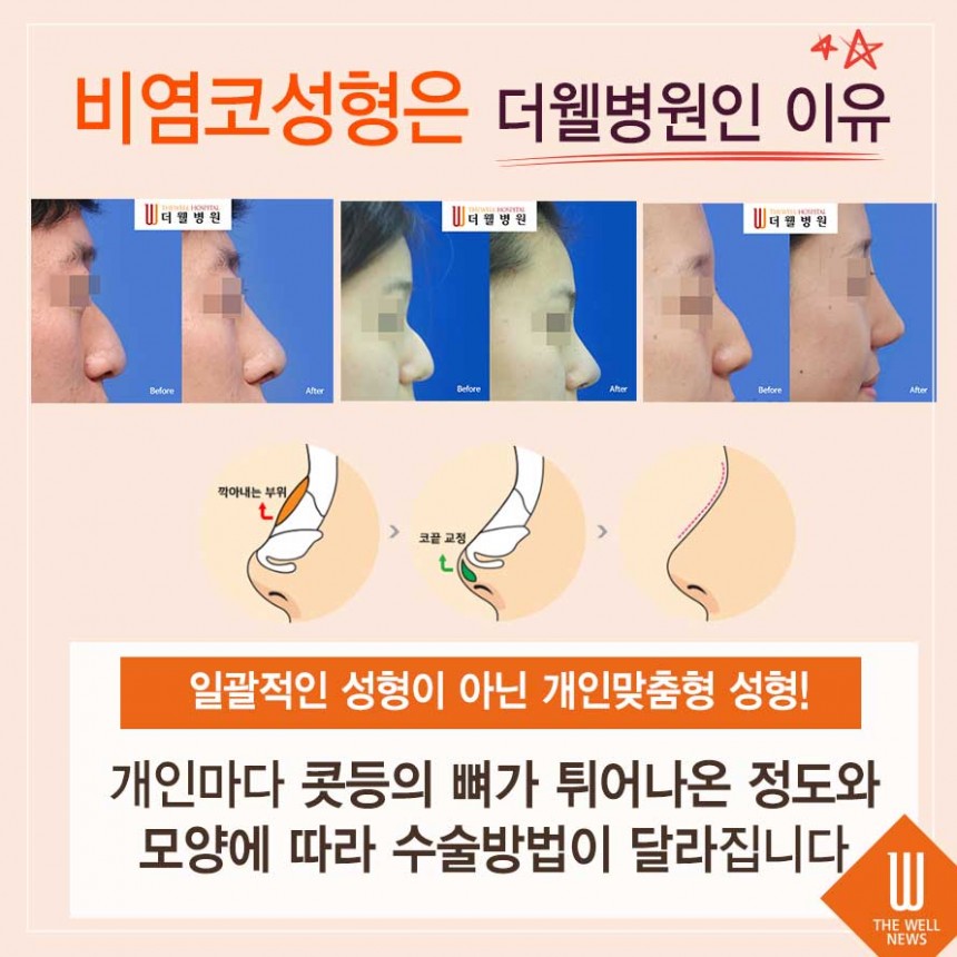 사나운 인상 매부리코성형 비염까지 한 번에 해결! (5/6)