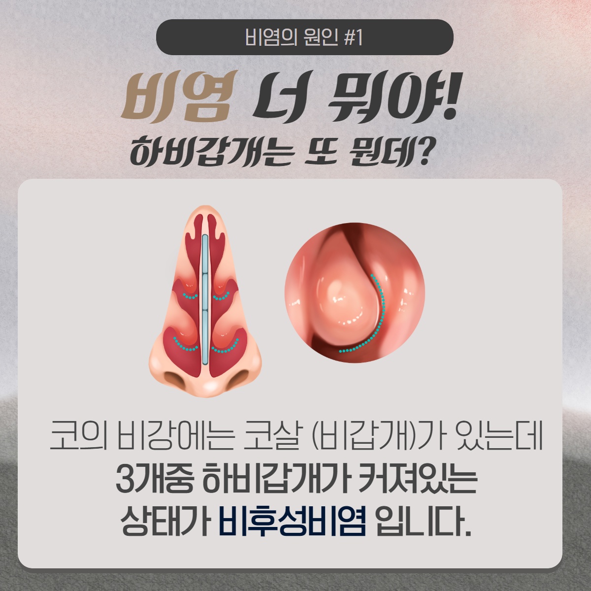 [수원 이비인후과] 틈만 나면 흐르는 콧물 원인은? (2/10)