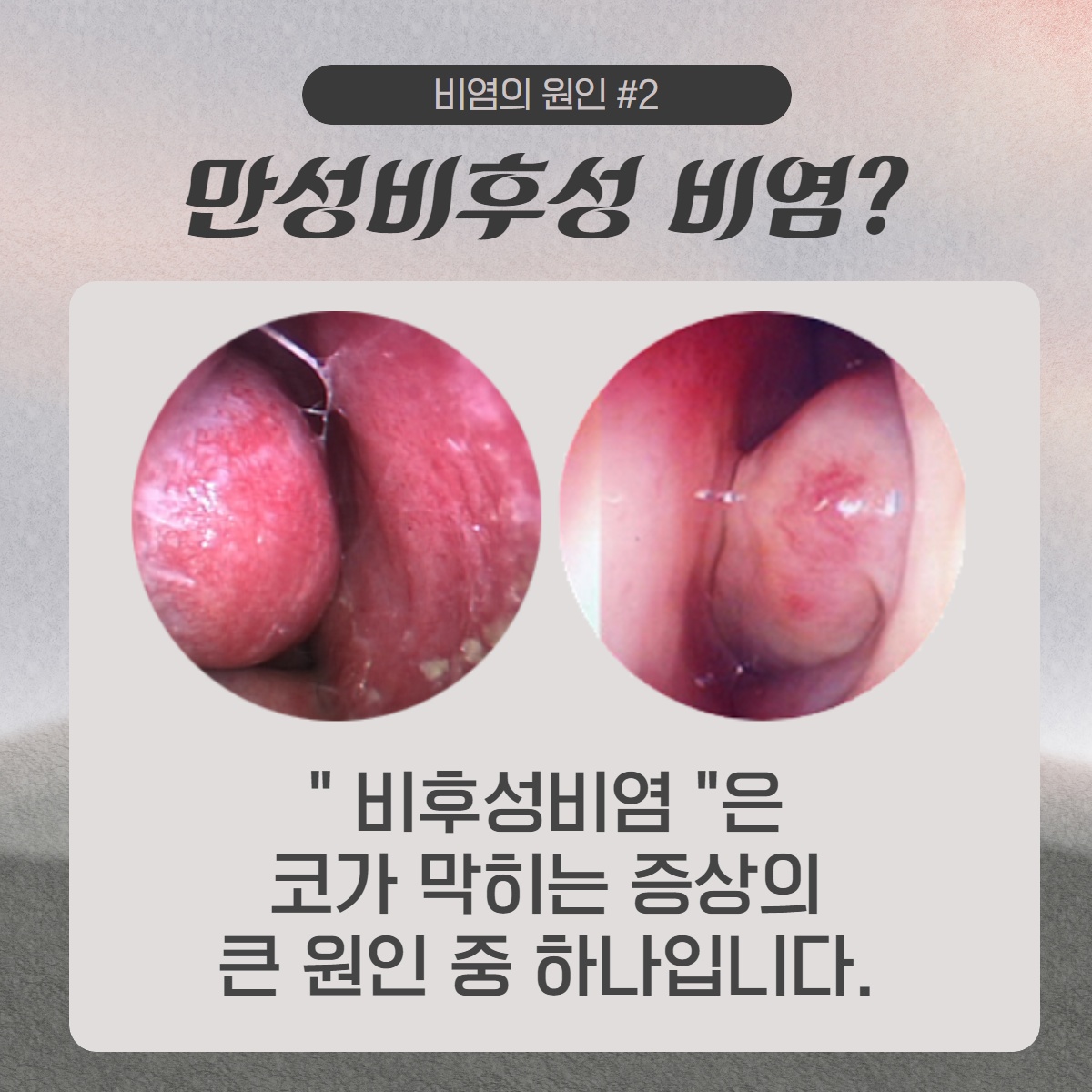 [수원 이비인후과] 틈만 나면 흐르는 콧물 원인은? (3/10)