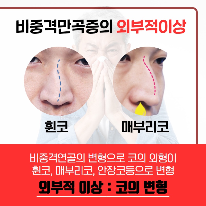 휜 코, 외모만의 문제일까? (5/10)