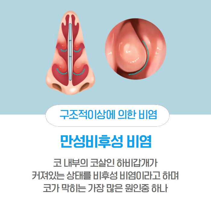 [수원 이비인후과] 콧물이 나는 이유 감기가 아닐 수도. (5/14)