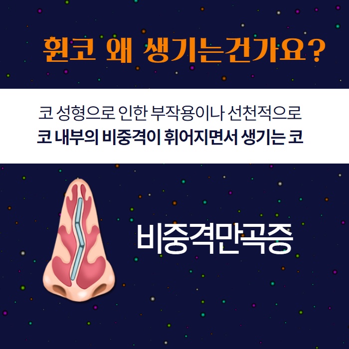 휜 코, 휘어진 코 왜 생기는 것일까? (2/9)