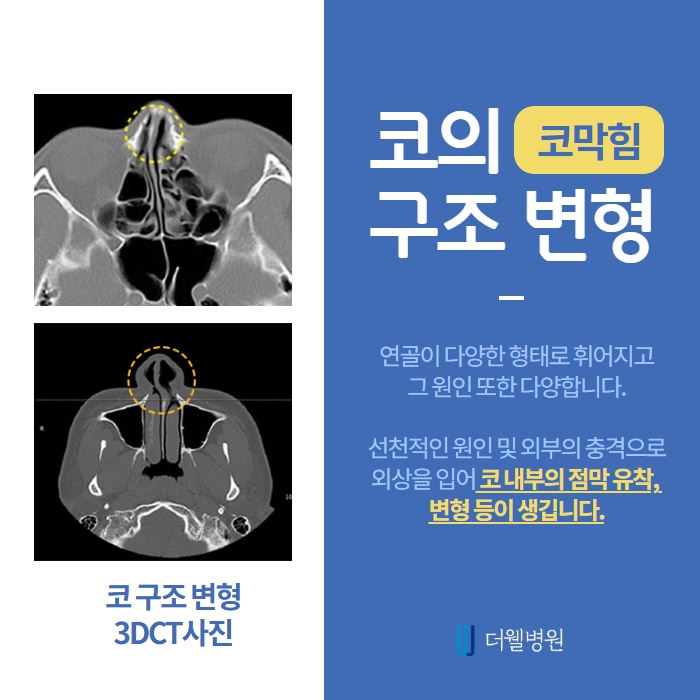 숨을 쉬기가 힘들어요! 비중격 만곡증이란? (3/10)