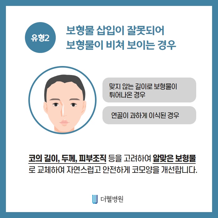 유형별 코재수술 (4/10)