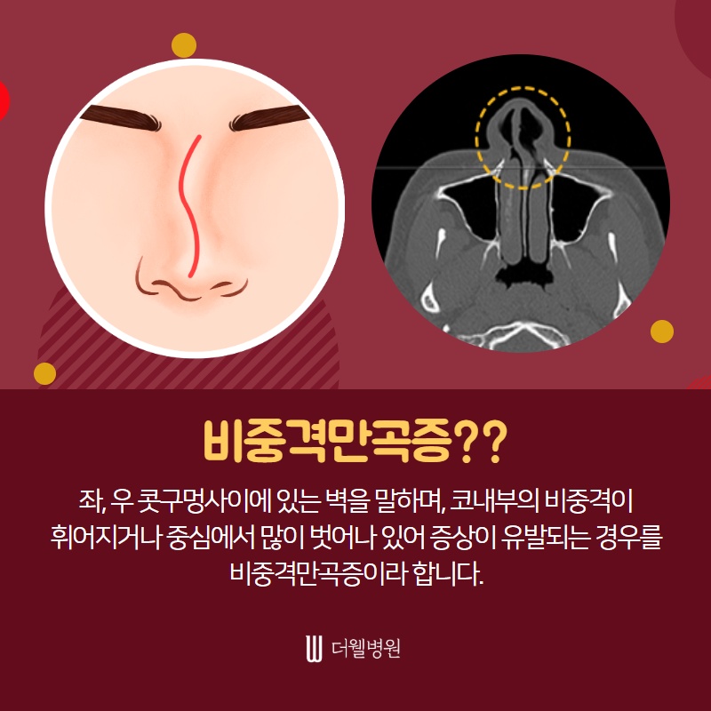 매부리코 수술, 코막힘까지 해결하자! (4/10)