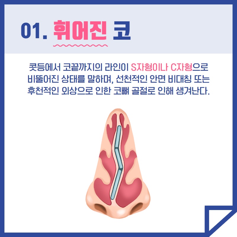 휘어진 코 성형 수술 (2/9)
