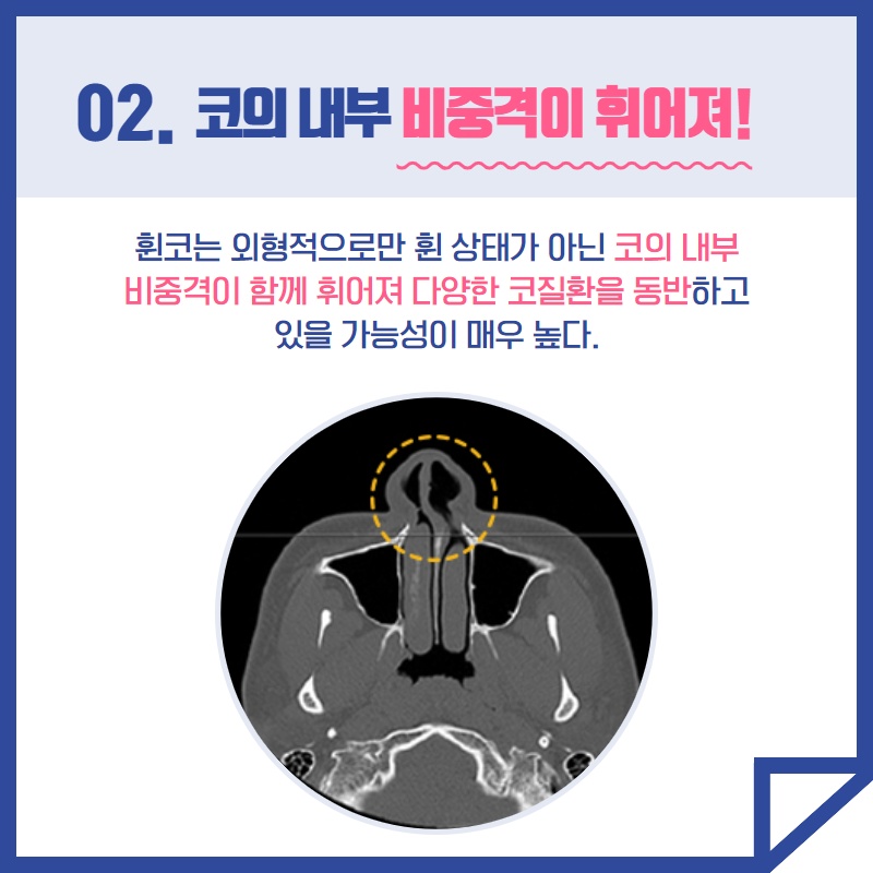 휘어진 코 성형 수술 (3/9)