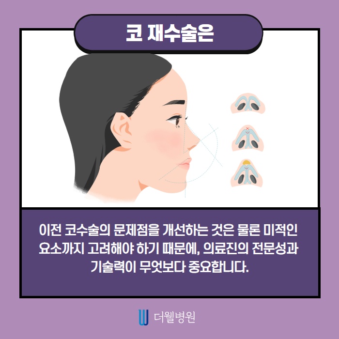 코 재수술 키포인트는? (5/10)