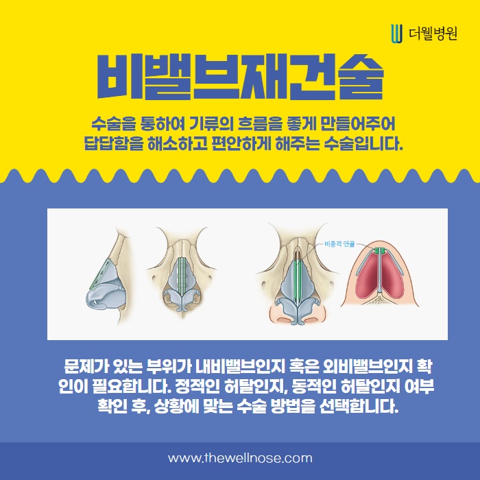 당신의 비밸브 상태는 어떤가요? (5/14)
