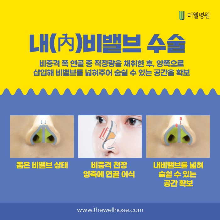 당신의 비밸브 상태는 어떤가요? (6/14)