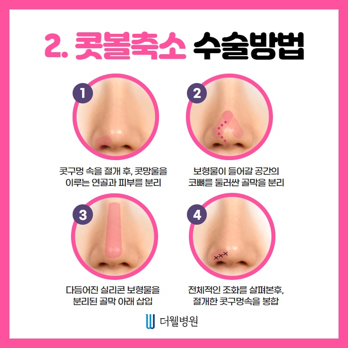 낮은 코, 오똑하게! (3/9)