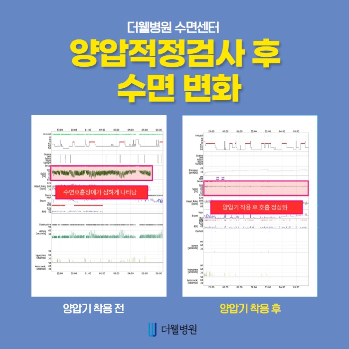 올바른 양압기 선택방법과 보험여부! (4/10)