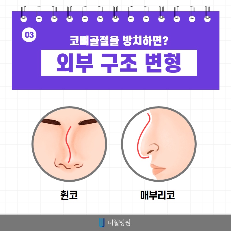 코 뼈 골절, 치료 시기가 중요합니다! (4/10)