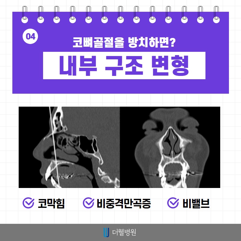 코 뼈 골절, 치료 시기가 중요합니다! (5/10)