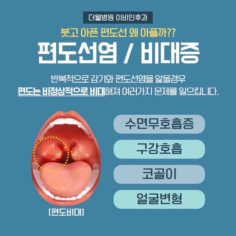건조한 환절기에 더 붓고 아픈 편도선 제대로 알고 치료하세요! (4/9)