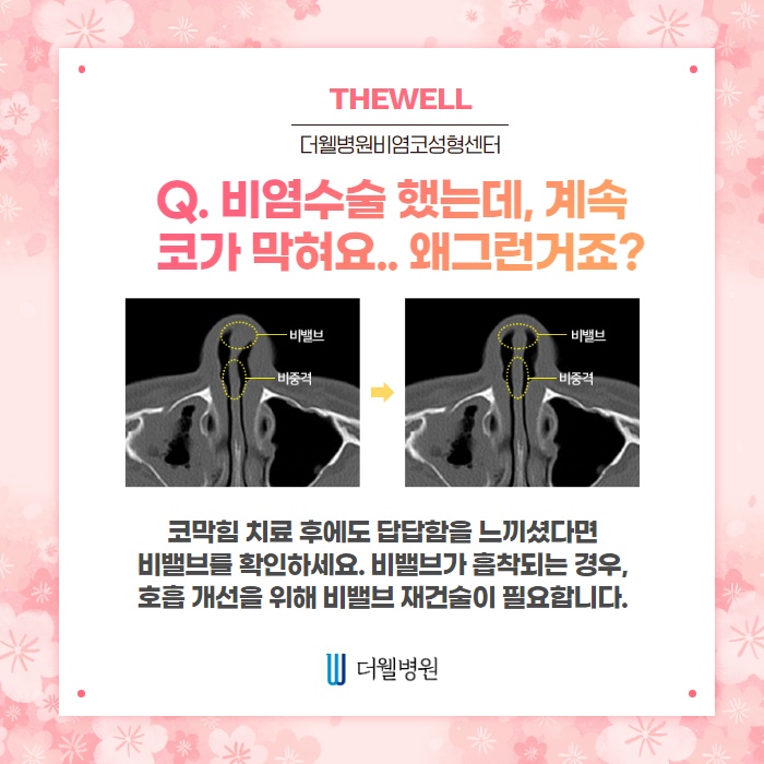 비염수술 코성형 Q&A! (4/10)
