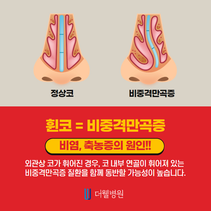 휜 코 성형, 질환까지 개선하자! (2/10)