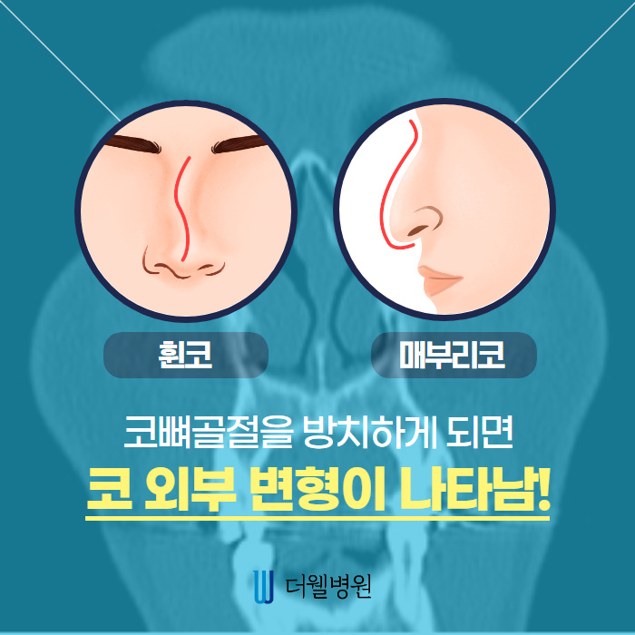 코 뼈 골절 빠른 시기에 치료해야합니다! (4/10)