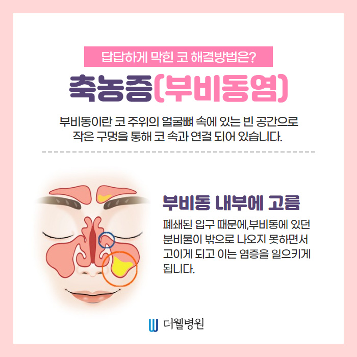축농증(부비동염) 치료방법은?! (2/11)