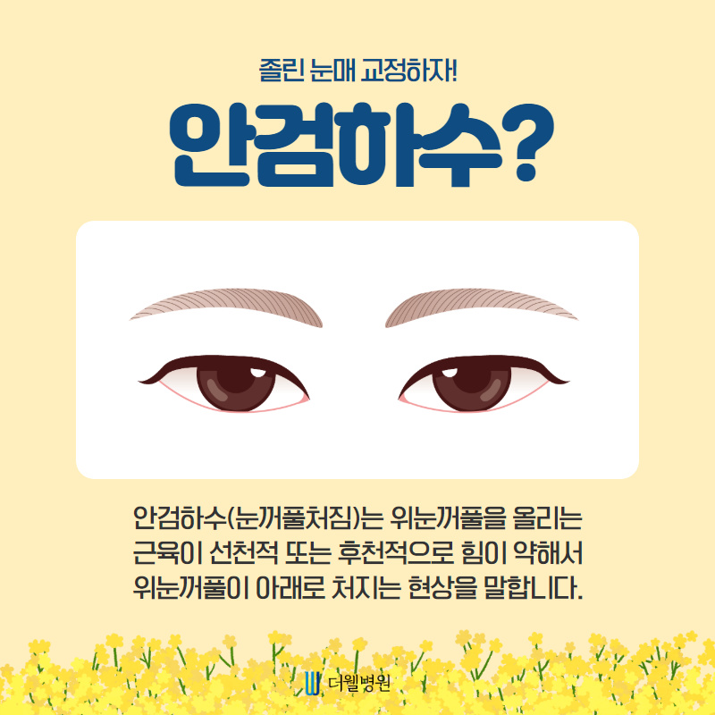 안검하수, 쌍꺼풀이 아닌 눈매교정으로 개선하세요! (3/10)