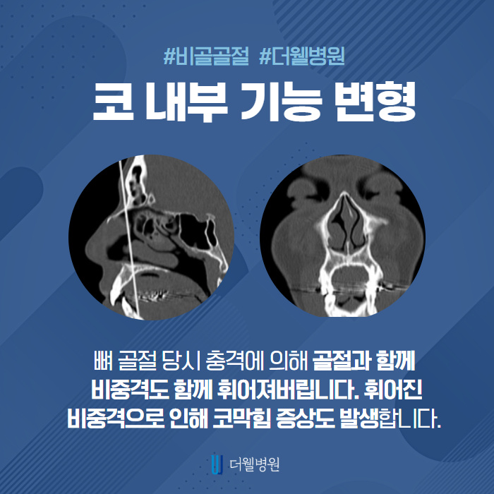 코 뼈가 부러졌다면 신속하게 치료! (5/10)