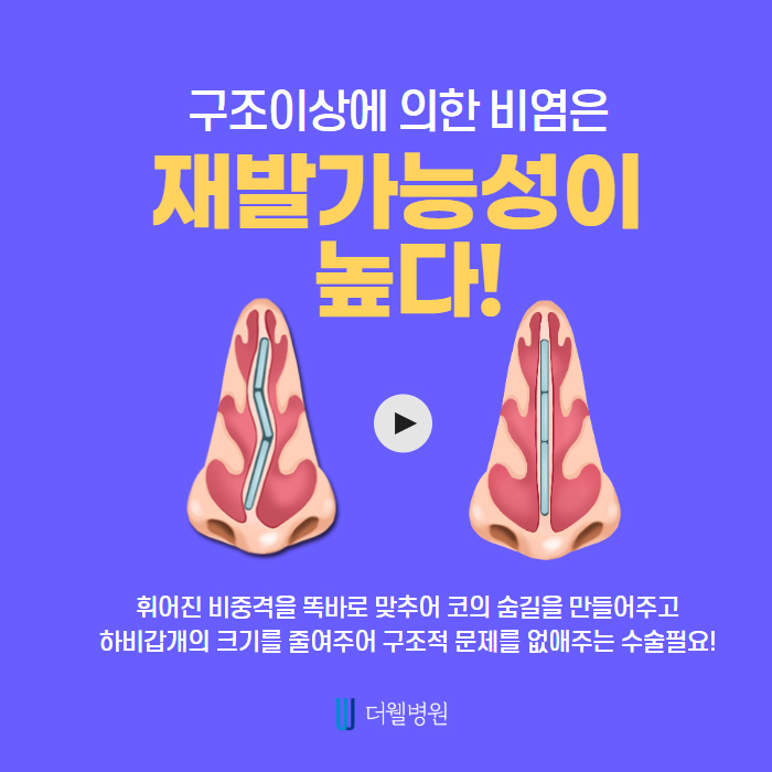 비염수술과 코성형을 한번에 한다고? (3/9)