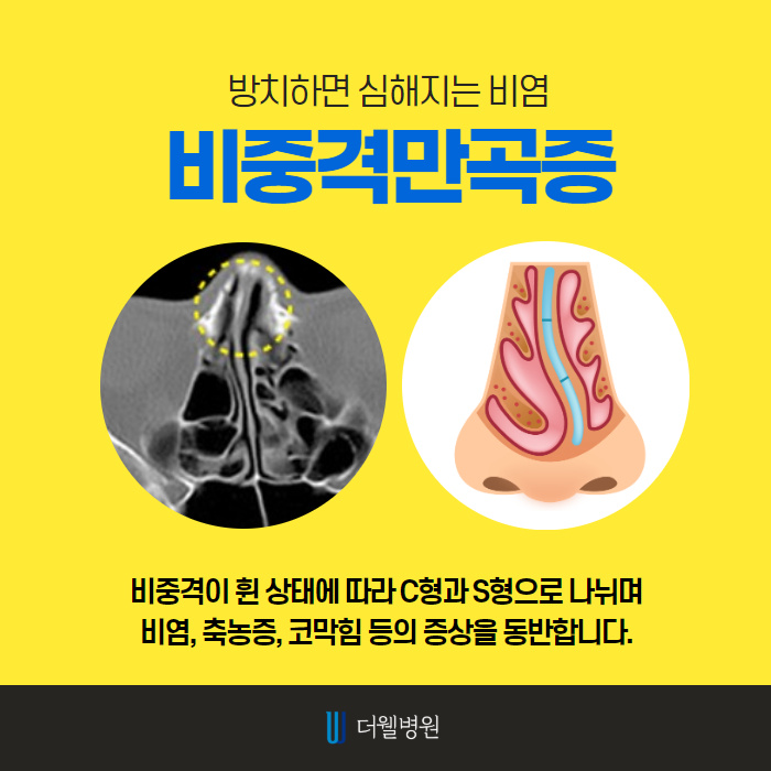 비염수술을 해야하는 이유?! (3/10)