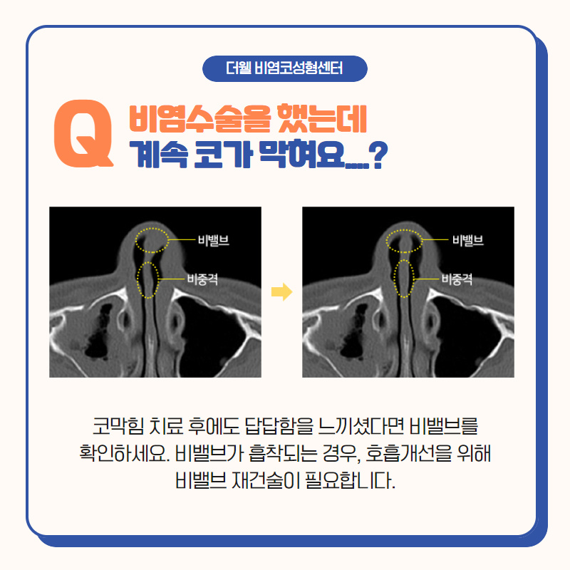 코수술에 대한 모든 궁금증을 풀어드립니다! (4/9)
