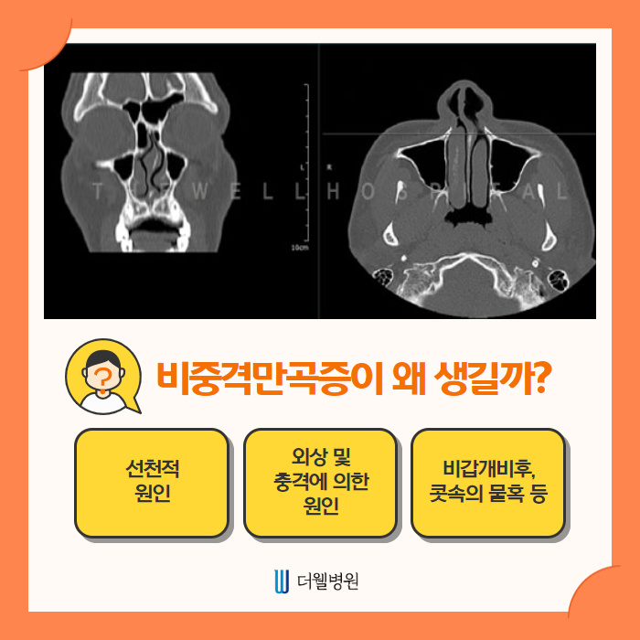휜 코 개선할 때 비중격만곡증 동시에 개선하세요~ (3/10)