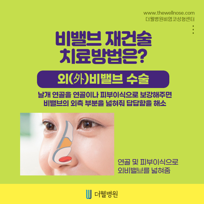 만성적인 코막힘 비밸브재건술로! (5/9)