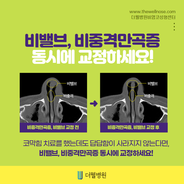 만성적인 코막힘 비밸브재건술로! (6/9)
