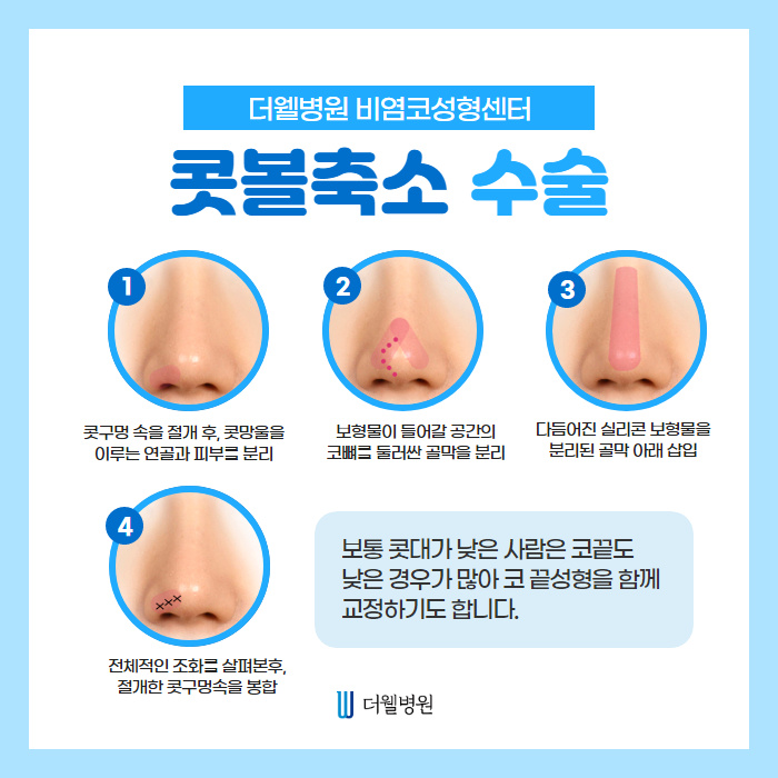 더웰병원 낮은코 성형