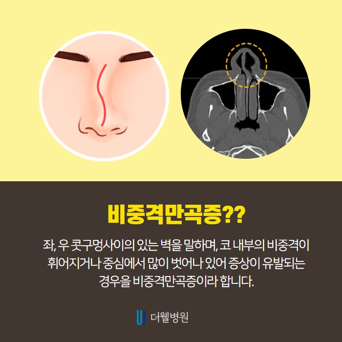 매부리코수술 코막힘 확인? (4/7)