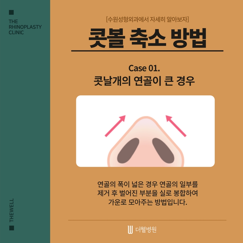 복코 수술, 수원성형외과에서 자세히 알아보자 (5/7)