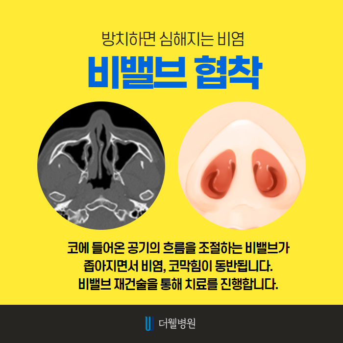 더웰병원 비염 수술