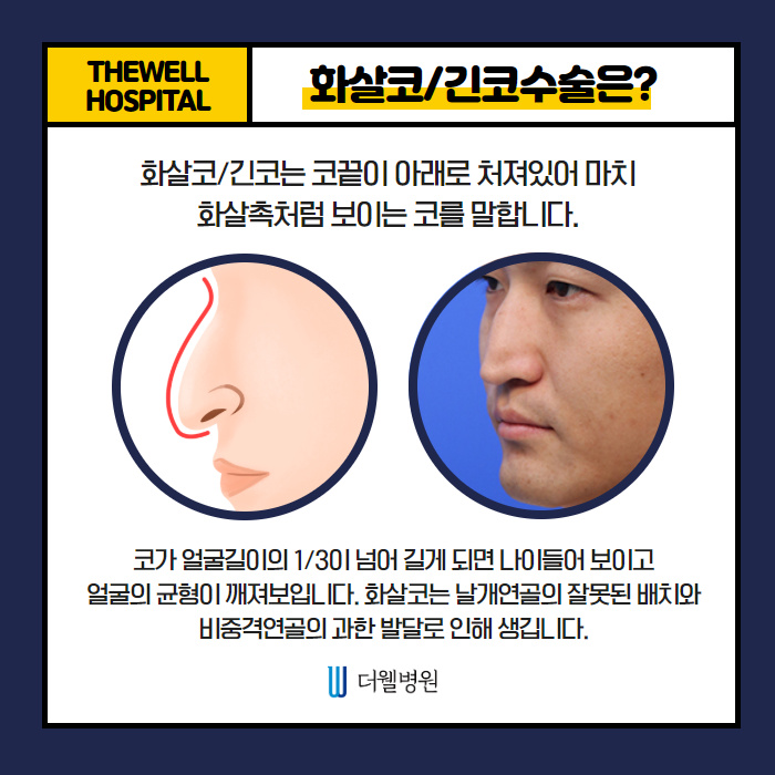 더웰병원 화살코·긴코 교정